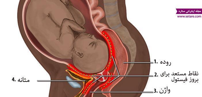 علت تکرر ادرار در بارداری چیست؟